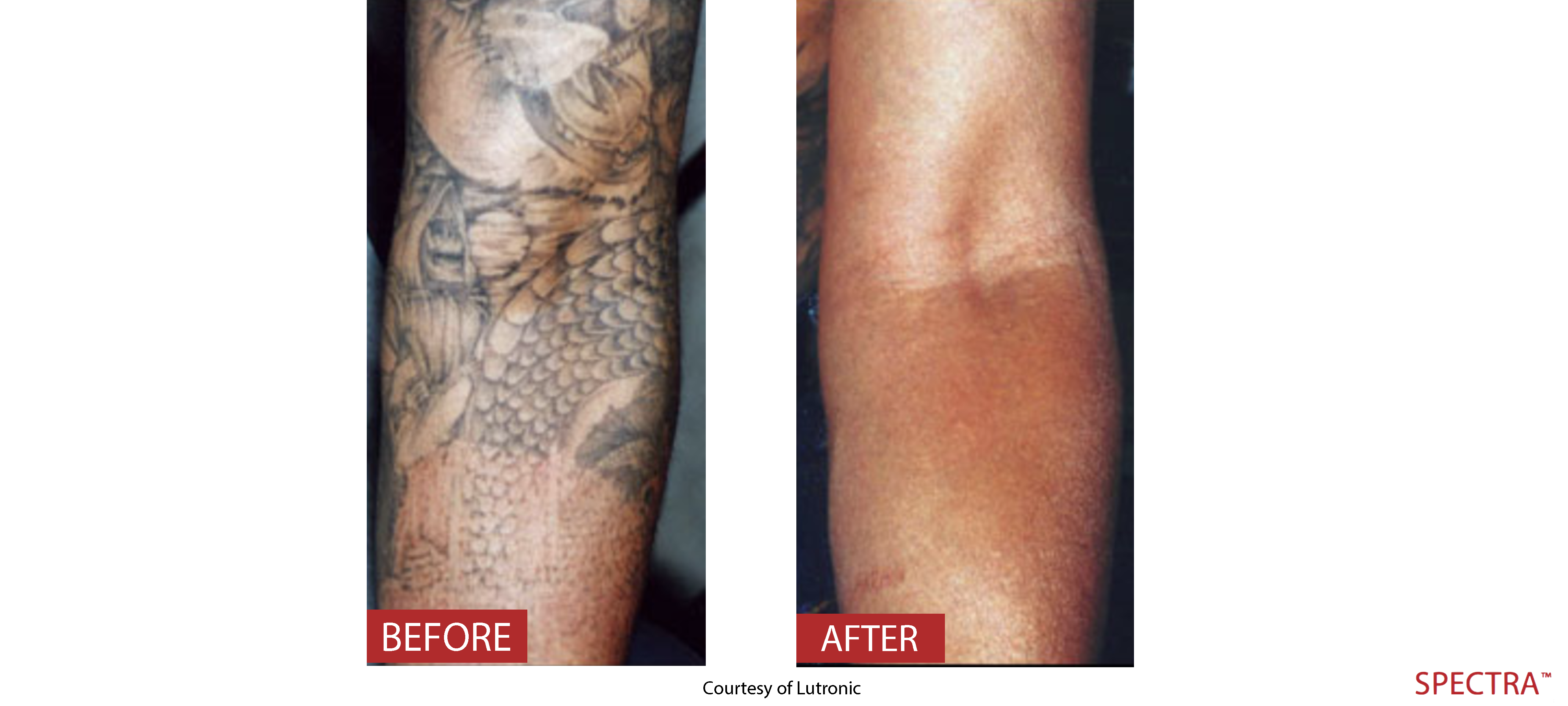 Laser Tattoo Removal Monarch Laser Services